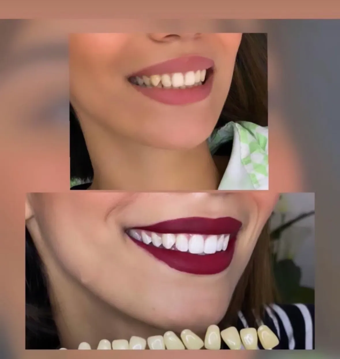 Sourire après blanchiment dentaire au cabinet